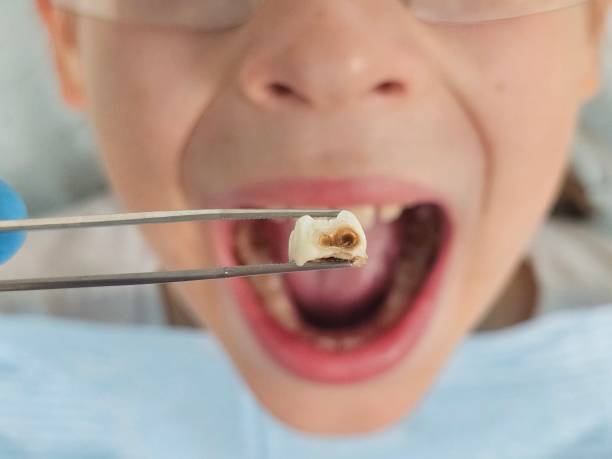 Best Chipped Tooth Repair Near Me  in Belleair, FL